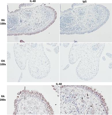 IL-40: A New B Cell-Associated Cytokine Up-Regulated in Rheumatoid Arthritis Decreases Following the Rituximab Therapy and Correlates With Disease Activity, Autoantibodies, and NETosis